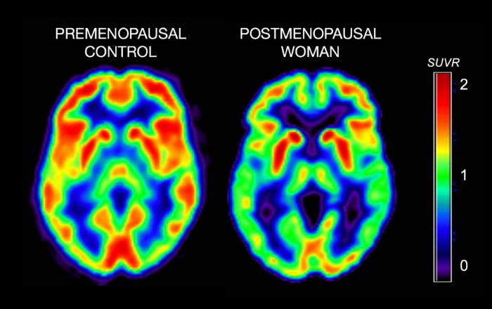 hypometabolism is characteristic of the post-menopausal brain