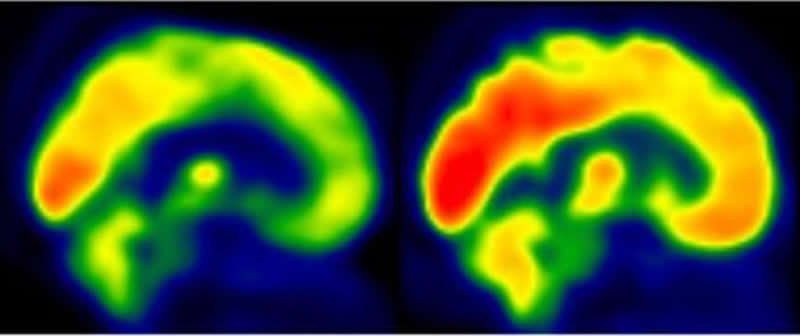 mri image of glucose metabolism