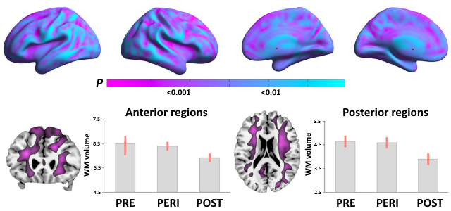 disappearing white matter volumes